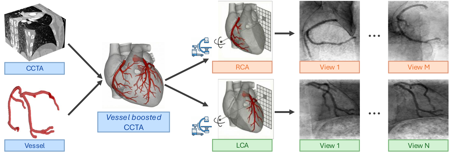 DRR generation pipeline: a CCTA volume and its coronary vessels are combined into a vessel-boosted CCTA, then projected under simulated C-arm geometry into routine RCA and LCA angiographic views.